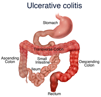 Image result for image of ulcerative colitis
