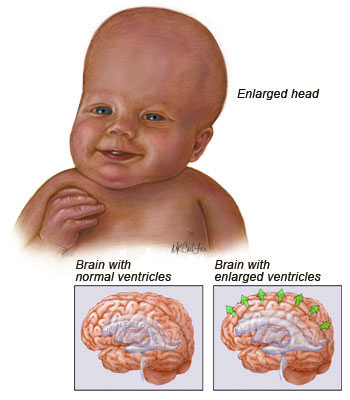 What causes Hyderocephalus image