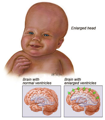 What are some symptoms of fluid on the brain?