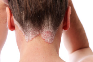 symptoms of Psoriasis image