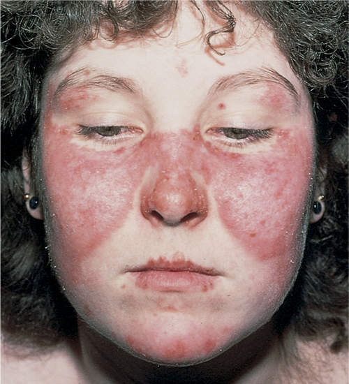 Does Lupus Butterfly Rash Feel Warm At Eva McCray Blog