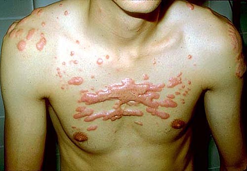 what is keloid scar image