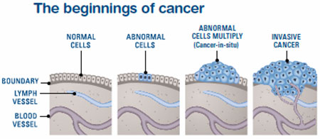 how cancer grows image