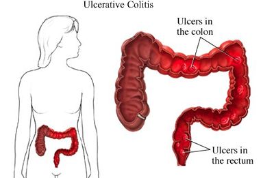 What is Ulcerative Colitis image