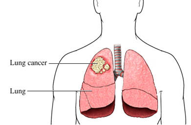 treatment of lungs cancer in homeopathy image