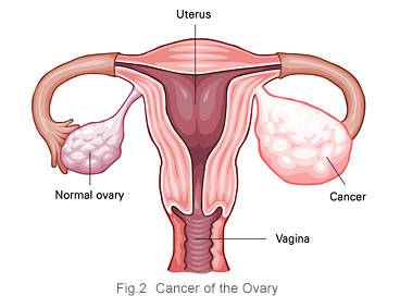 treatment of ovarian cancer in homeopathy image