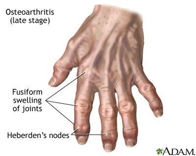 Osteoarthritis treatment in homeopathy image