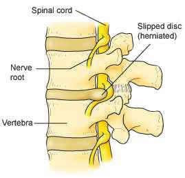 Normal and herniated discs image