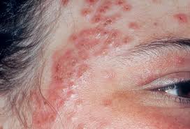What is eczema image