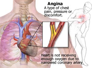 what is angina image