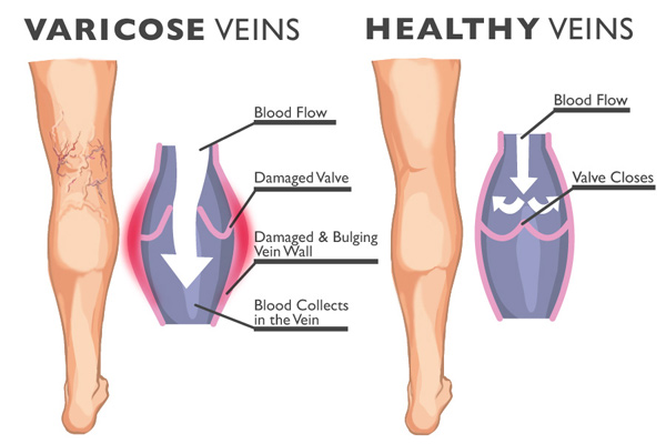 healthy and varicose veins image