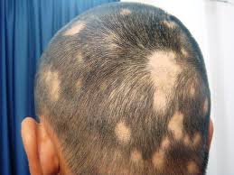 patcy hair loss in Alopecia-areata image