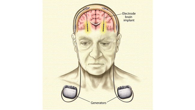Electrode placement in brain to treat Parkinson's Disease