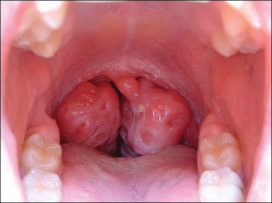 Enlarged and Swolling tonsils image