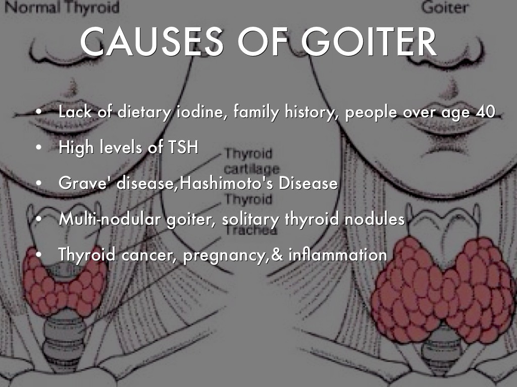 Main Causes of Goiter Image