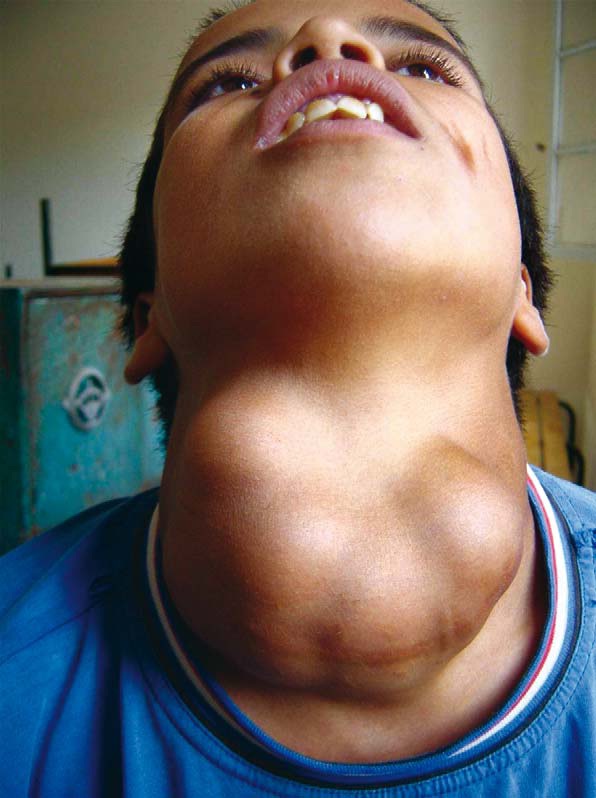 what is goiter image