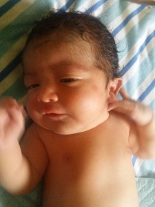 Hydrocephalus baby cured image