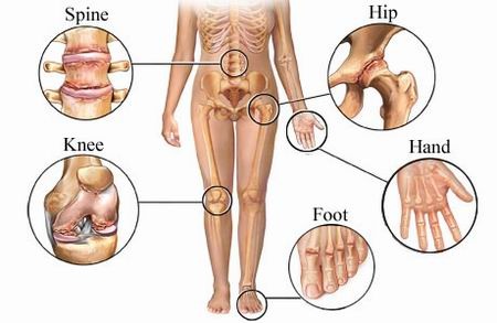 Arthritis Pain Points Image