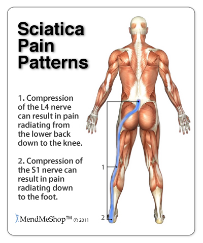 patterns of sciatic pain image