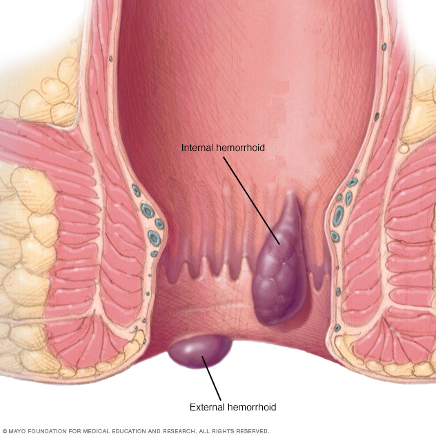 hemorrhoids homeopathic treatment