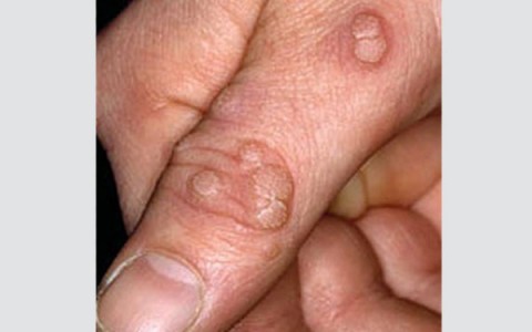 what is warts and causes