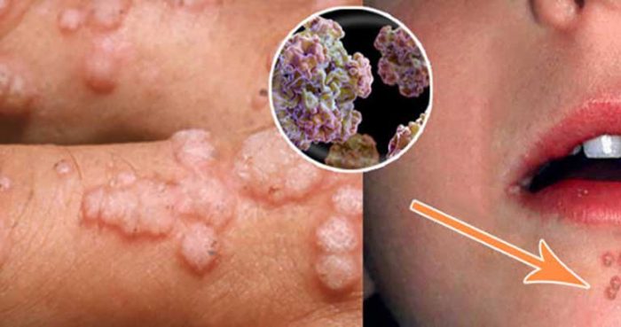 Symptoms of Warts and homeopathic treatment