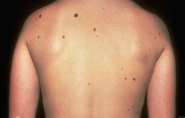 what is mole and treatment in homeopathic