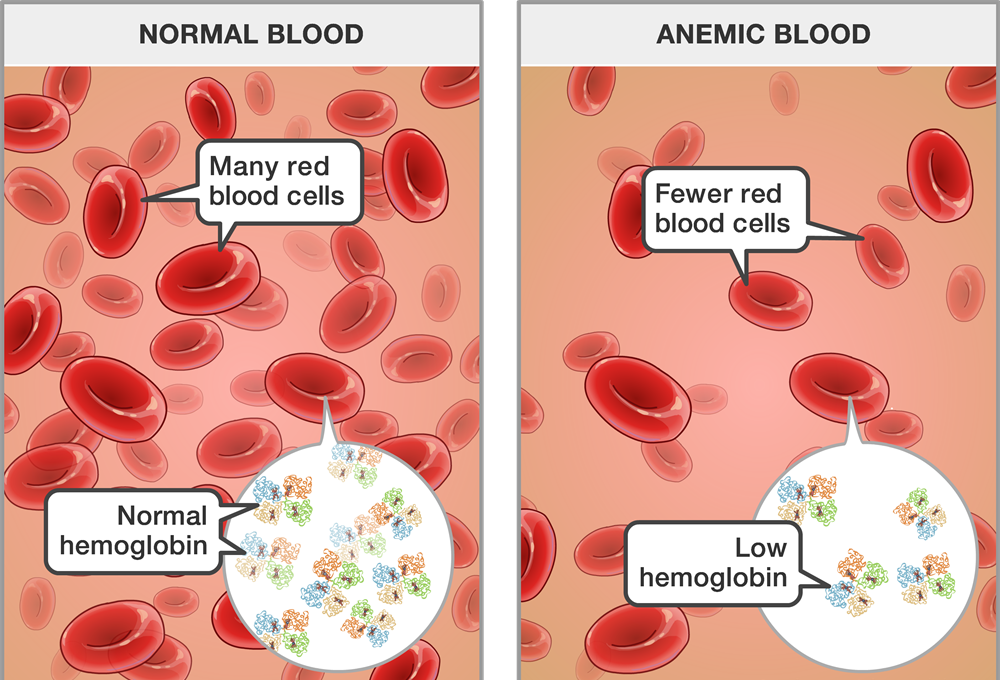 Dr Sabeel Anemia Causes Diagnosis and Homeopathic treatment