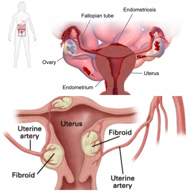 Dysmenorrhea Symptoms Diagnosis Causes Treatment Homeopathic Treatment Fibroid Causes